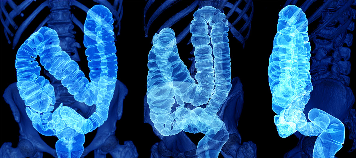 An image of an intestine, compiled using computerised tomography scans.